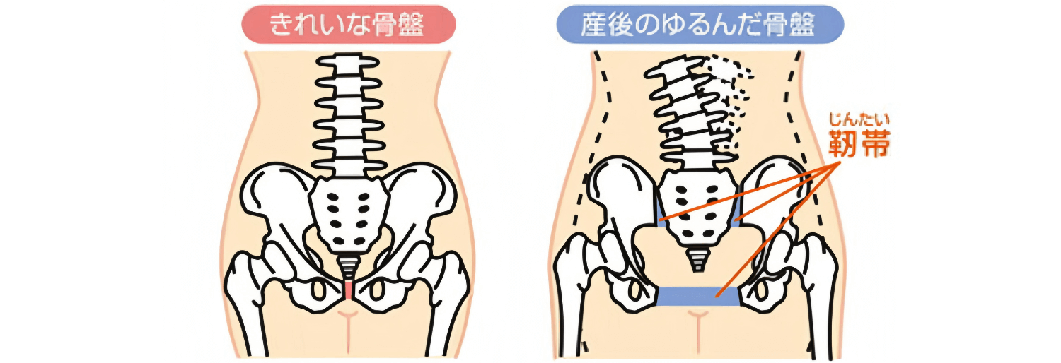 産後のゆがんだ骨盤のイラスト